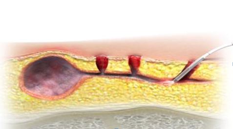 kysti kokkygos charisis christos xeirourgos thessaloniki 1